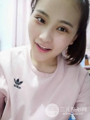 雙眼皮多項(xiàng)整形整形案例以及前后對(duì)比圖分享——濟(jì)南愛容路傳燕醫(yī)生做的~