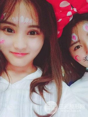 雙眼皮多項(xiàng)整形整形案例以及前后對(duì)比圖分享——濟(jì)南愛容路傳燕醫(yī)生做的~