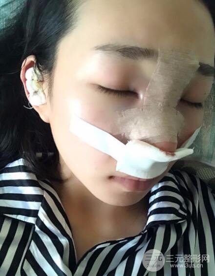 隆鼻整形價(jià)格和真人案例