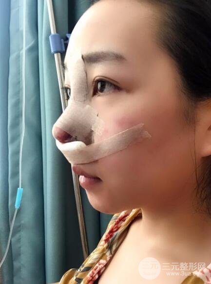 隆鼻整形價(jià)格和真人案例