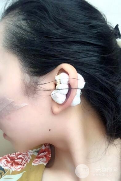 隆鼻整形價(jià)格和真人案例