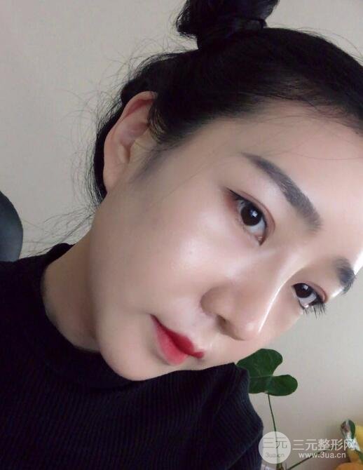 隆鼻整形價(jià)格和真人案例