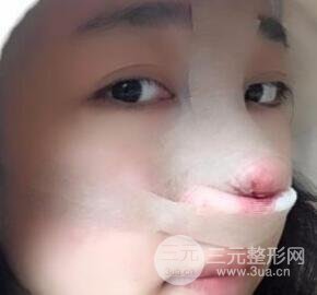 隆鼻整形價(jià)格和真人案例