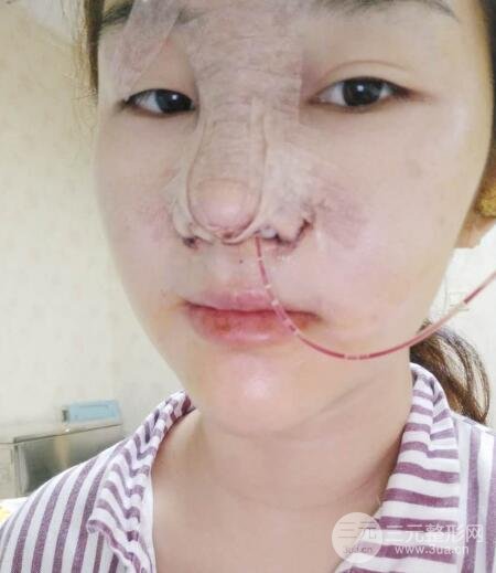 蒜頭鼻整形價(jià)格和對(duì)比照片案例