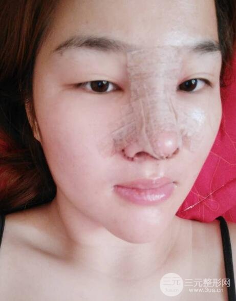 蒜頭鼻整形價(jià)格和對(duì)比照片案例