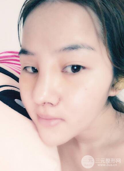 蒜頭鼻整形價(jià)格和對(duì)比照片案例