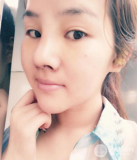 蒜頭鼻整形價(jià)格和對(duì)比照片案例