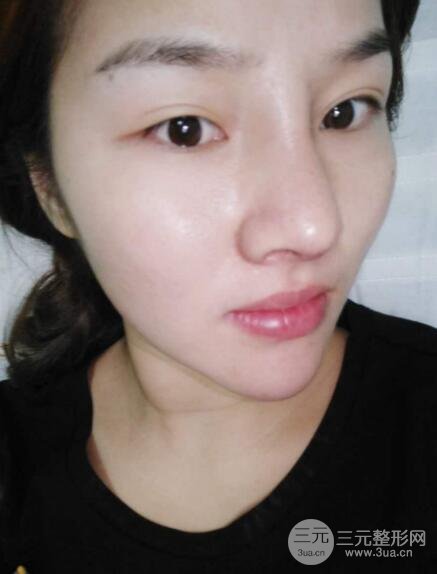 蒜頭鼻整形價(jià)格和對(duì)比照片案例