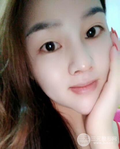 蒜頭鼻整形價(jià)格和對(duì)比照片案例