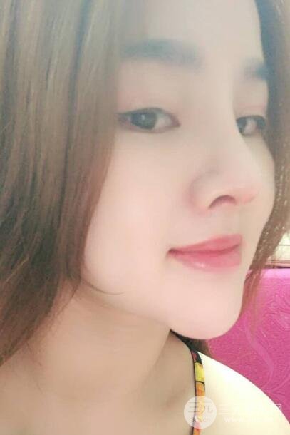 蒜頭鼻整形價(jià)格和對(duì)比照片案例