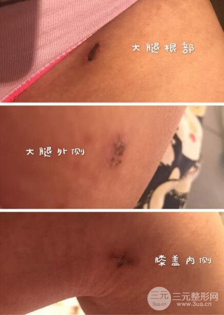 大腿環(huán)吸抽脂價(jià)格和圖片案例