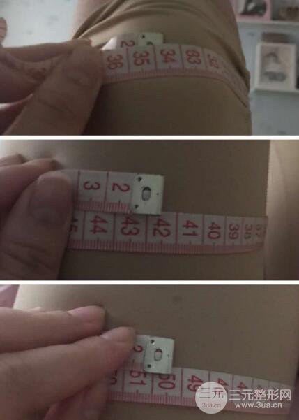 大腿環(huán)吸抽脂價(jià)格和圖片案例