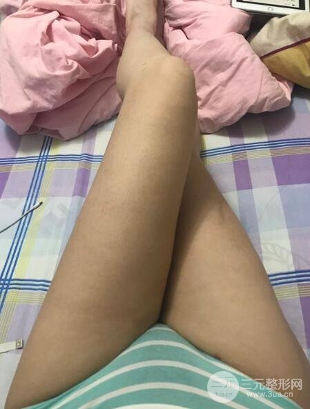 大腿環(huán)吸抽脂價(jià)格和圖片案例