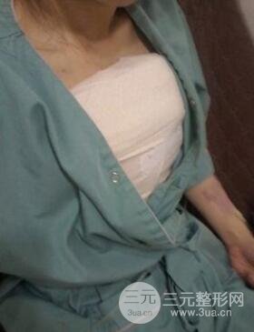 濰坊華美任傳琦給我做的假體隆胸手術(shù)，給大家分享一下前后照片