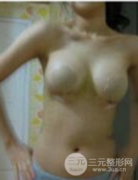 濰坊華美任傳琦給我做的假體隆胸手術(shù)，給大家分享一下前后照片