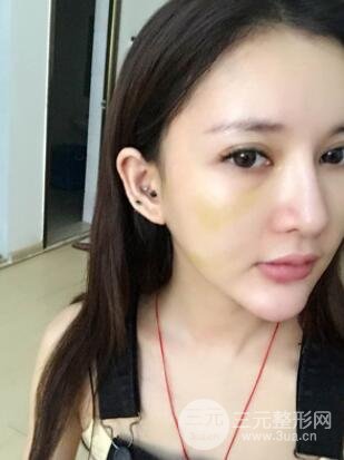 我的埋埋蛋白線.提升日記：真實(shí)案例——濰坊華美童艷梅醫(yī)生做的