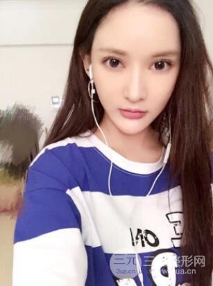 我的埋埋蛋白線.提升日記：真實(shí)案例——濰坊華美童艷梅醫(yī)生做的