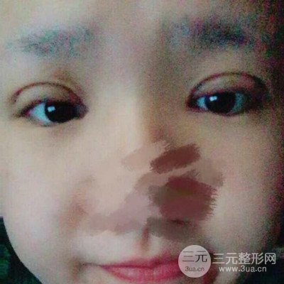 汕頭愛(ài)麗諾蘇國(guó)藝給我做的雙眼皮手術(shù)，把前后的對(duì)比圖片分享給大家