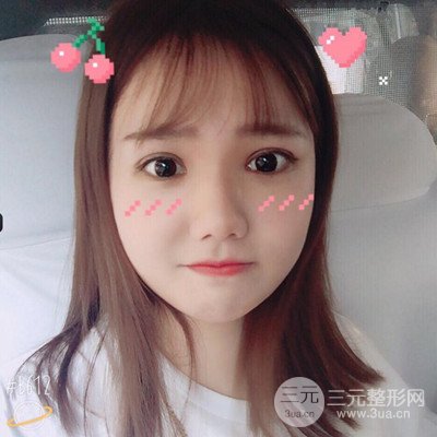 汕頭愛(ài)麗諾蘇國(guó)藝給我做的雙眼皮手術(shù)，把前后的對(duì)比圖片分享給大家