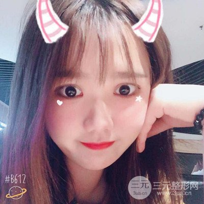 汕頭愛(ài)麗諾蘇國(guó)藝給我做的雙眼皮手術(shù)，把前后的對(duì)比圖片分享給大家