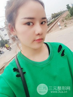 硅膠假體墊下巴真實(shí)案例，汕頭愛(ài)麗諾蘇國(guó)藝做的