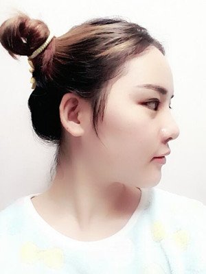 硅膠假體墊下巴真實(shí)案例，汕頭愛(ài)麗諾蘇國(guó)藝做的