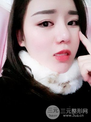 硅膠假體墊下巴真實(shí)案例，汕頭愛(ài)麗諾蘇國(guó)藝做的