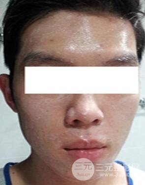 汕頭愛麗諾時慧醫(yī)生給我做的祛痘，看看前后果如何