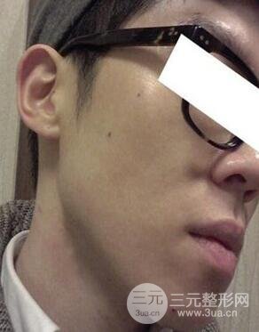 汕頭愛麗諾時慧醫(yī)生給我做的祛痘，看看前后果如何