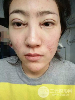 雙眼皮修復(fù)+開內(nèi)眼角真實(shí)案例附上前后對(duì)比圖片——汕頭伊麗莎白張紅軍做的