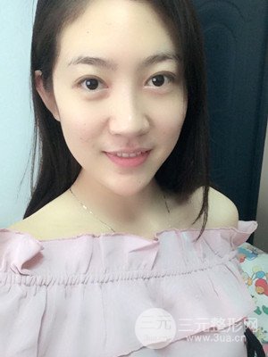 雙眼皮修復(fù)+開內(nèi)眼角真實(shí)案例附上前后對(duì)比圖片——汕頭伊麗莎白張紅軍做的