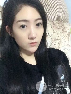 雙眼皮修復(fù)+開內(nèi)眼角真實(shí)案例附上前后對(duì)比圖片——汕頭伊麗莎白張紅軍做的