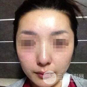 汕頭伊麗莎白張紅軍給我打的B****，分享一下前后照片