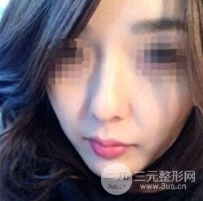 汕頭伊麗莎白張紅軍給我打的B****，分享一下前后照片