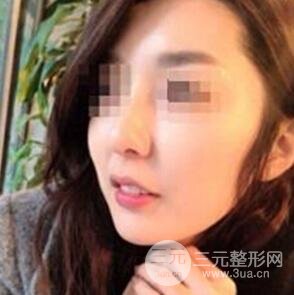 汕頭伊麗莎白張紅軍給我打的B****，分享一下前后照片