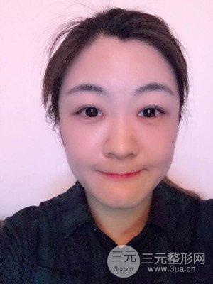 做了自體脂肪填充全臉日記分享——汕頭伊麗莎白孫杰醫(yī)生做的