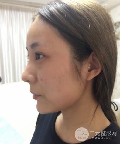 注射玻尿酸注射除皺緊致肌膚前后對比圖案例