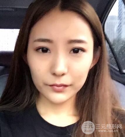 注射玻尿酸注射除皺緊致肌膚前后對比圖案例