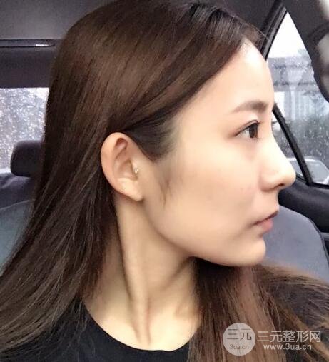 注射玻尿酸注射除皺緊致肌膚前后對比圖案例