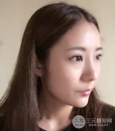 注射玻尿酸注射除皺緊致肌膚前后對比圖案例