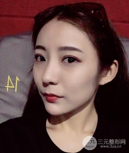 注射玻尿酸注射除皺緊致肌膚前后對比圖案例