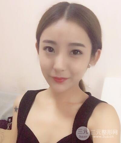 注射玻尿酸注射除皺緊致肌膚前后對比圖案例