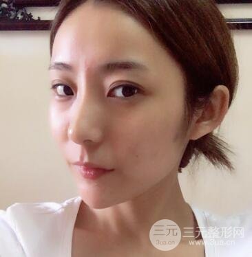 注射玻尿酸注射除皺緊致肌膚前后對比圖案例