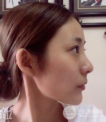 注射玻尿酸注射除皺緊致肌膚前后對比圖案例