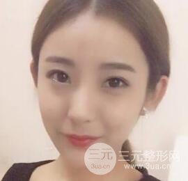 注射玻尿酸注射除皺緊致肌膚前后對比圖案例