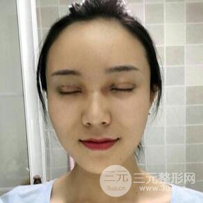 雙眼皮+開內(nèi)眼角手術(shù)前后對(duì)比圖片，真實(shí)案例