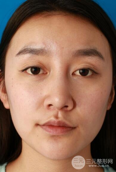 深圳源美做隆鼻失敗修復價格案例