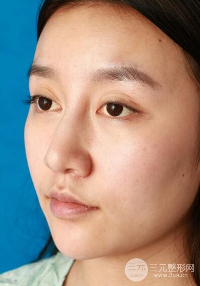 深圳源美做隆鼻失敗修復價格案例