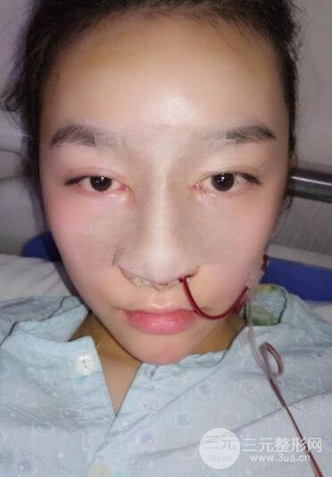 深圳源美做隆鼻失敗修復價格案例