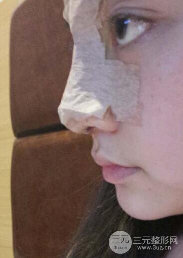 深圳源美做隆鼻失敗修復價格案例